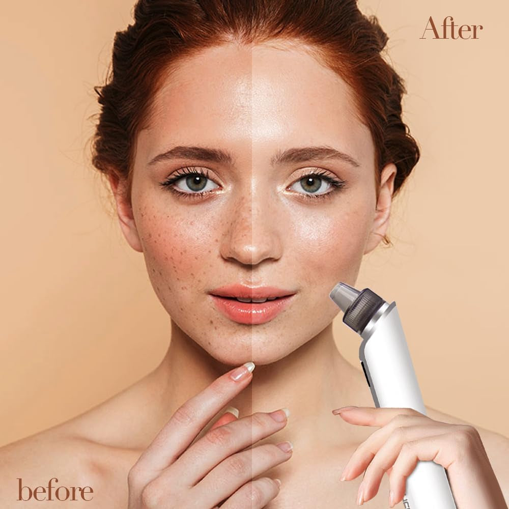 Ultimate Blackhead Remover – 6 Suction Powers, 4 Probes & LED Display for Deep Cleansing and Unclogging Pores