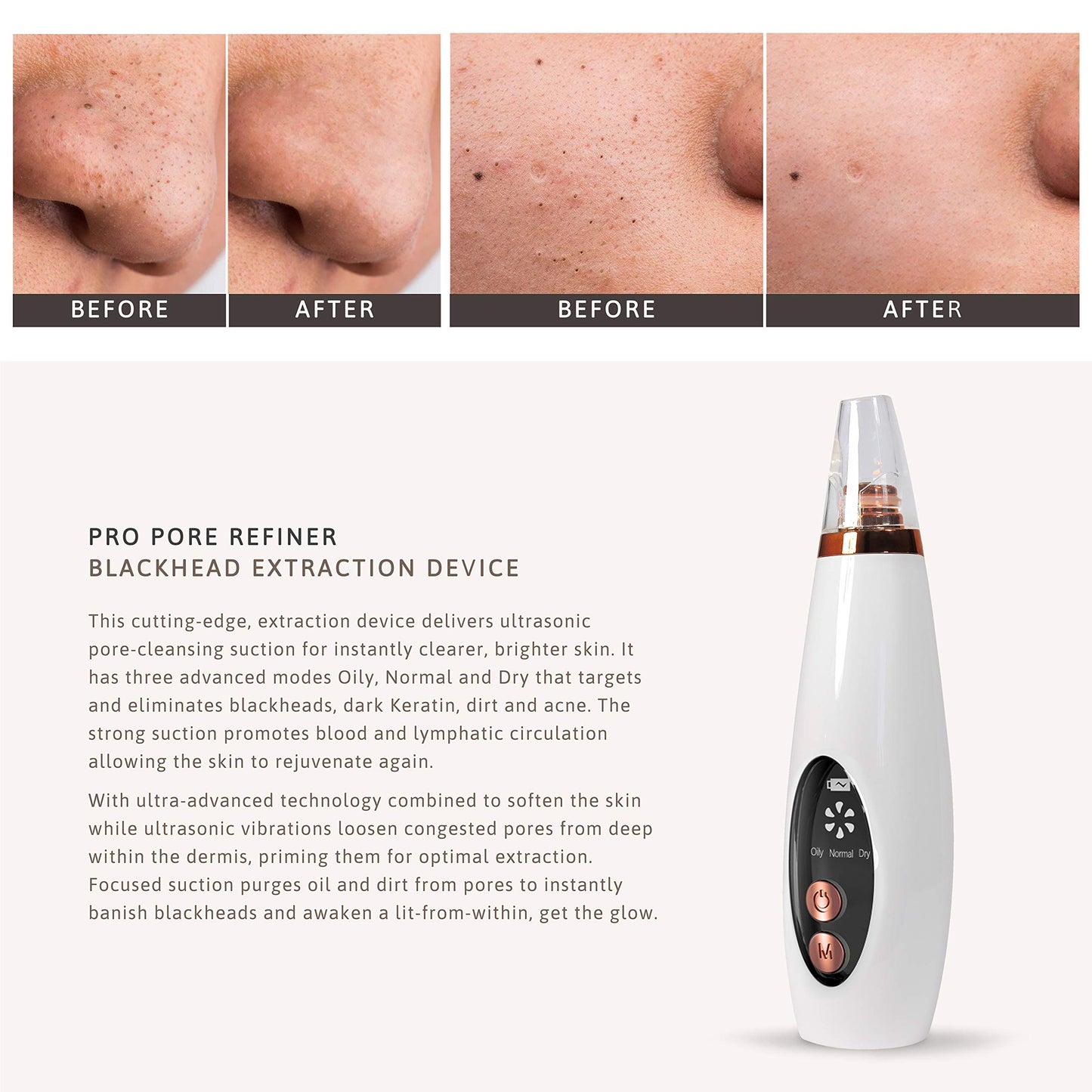 Blackhead Remover Vacuum – Powerful, Safe & Customizable