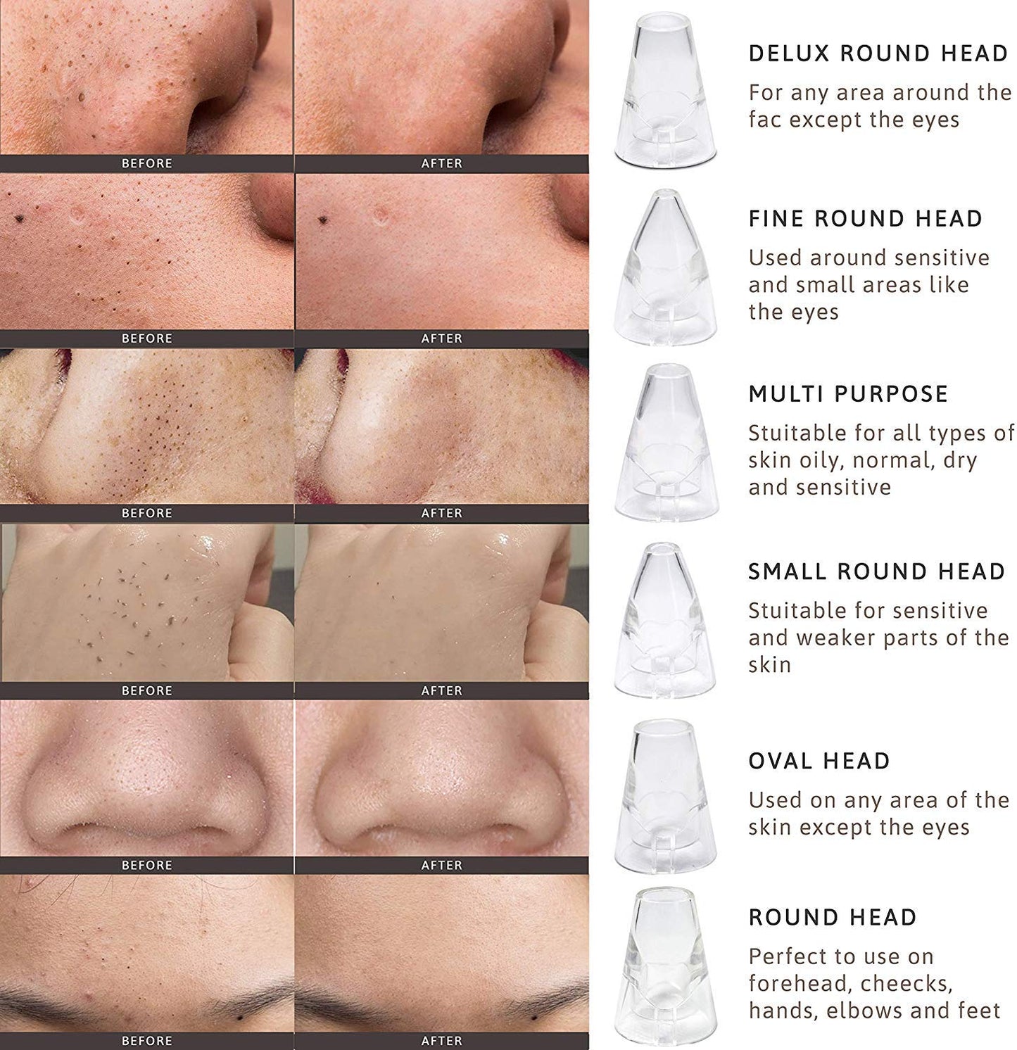 Blackhead Remover Vacuum – Powerful, Safe & Customizable